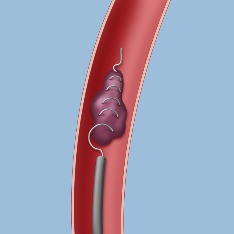 Surgery for Ischemic Stroke Weill Cornell Brain and