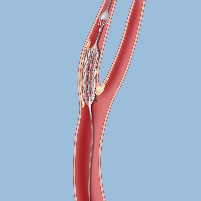 Carotid artery disease