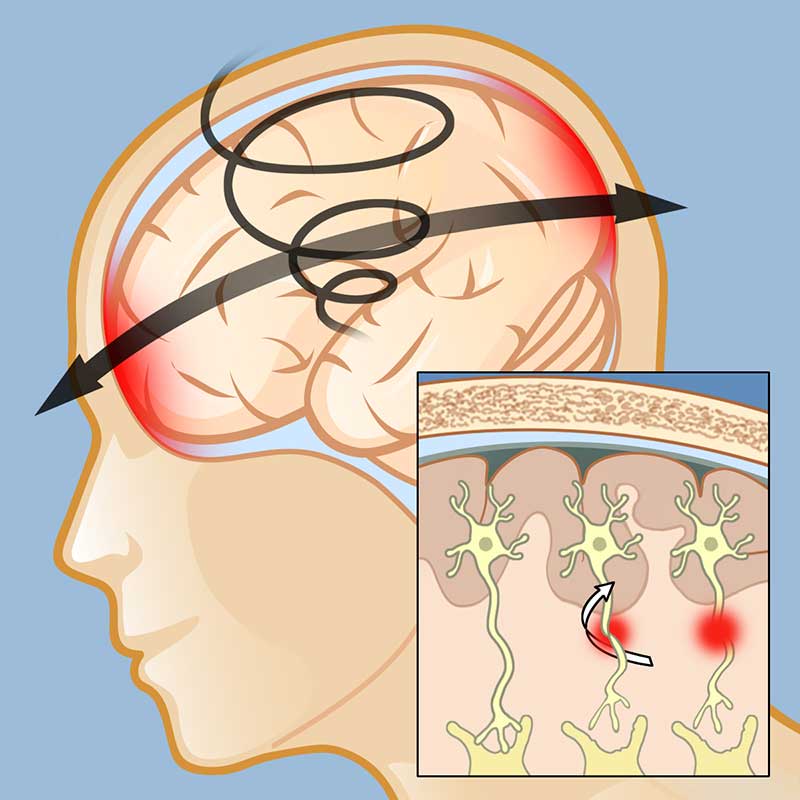 What Happens In Diffuse Axonal Injury