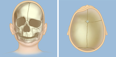 coronal craniosynostosis synostosis suture skull symptoms brain spine weillcornellbrainandspine