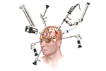 Minimally Invasive Cranial Neurosurgery at Weill Cornell Medicine Minimally Invasive Cranial Neurosurgery at Weill Cornell Medicine