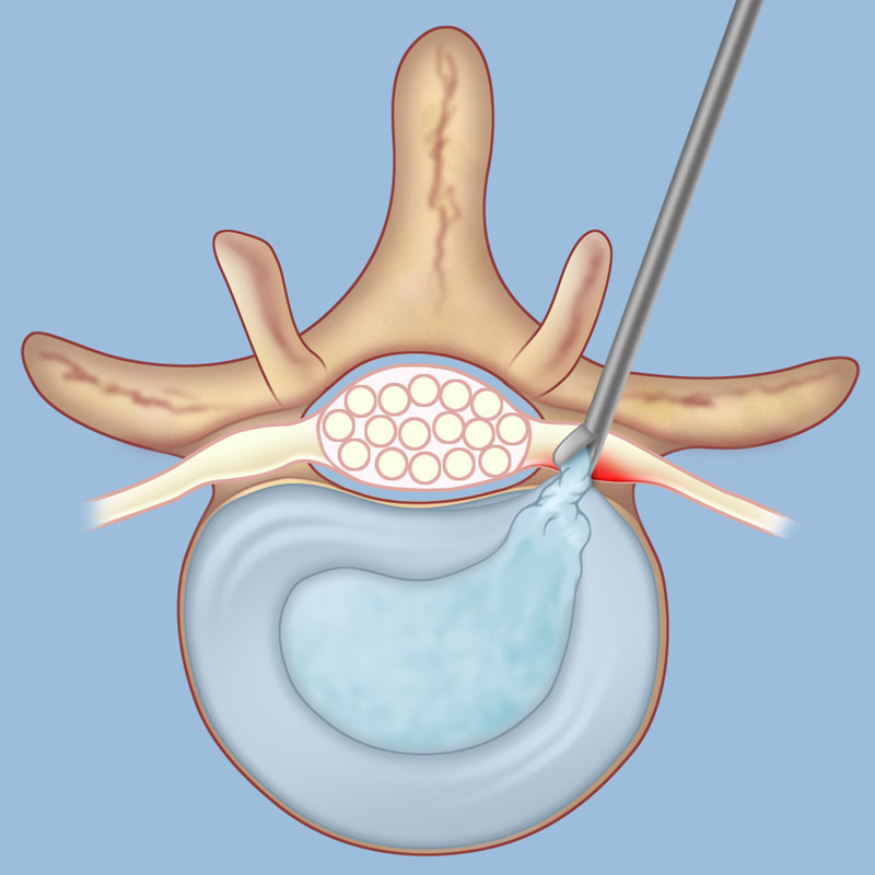 How long can you wait to have herniated disc surgery?