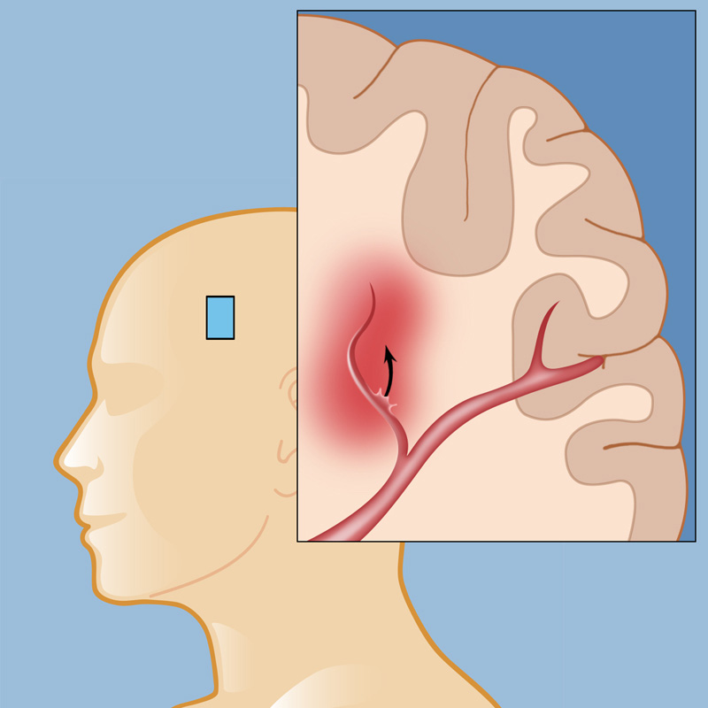 intracerebral-hemorrhage-weill-cornell-brain-and-spine-center