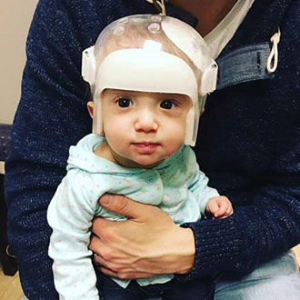 Kennedy McConnell in her helmet after endoscopic surgery for craniosynostosis