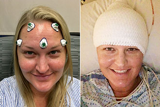 Rachel Lindquist before and after her awake craniotomy
