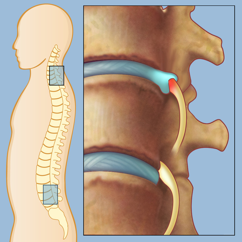 What Is Lower Lumbar Radiculopathy