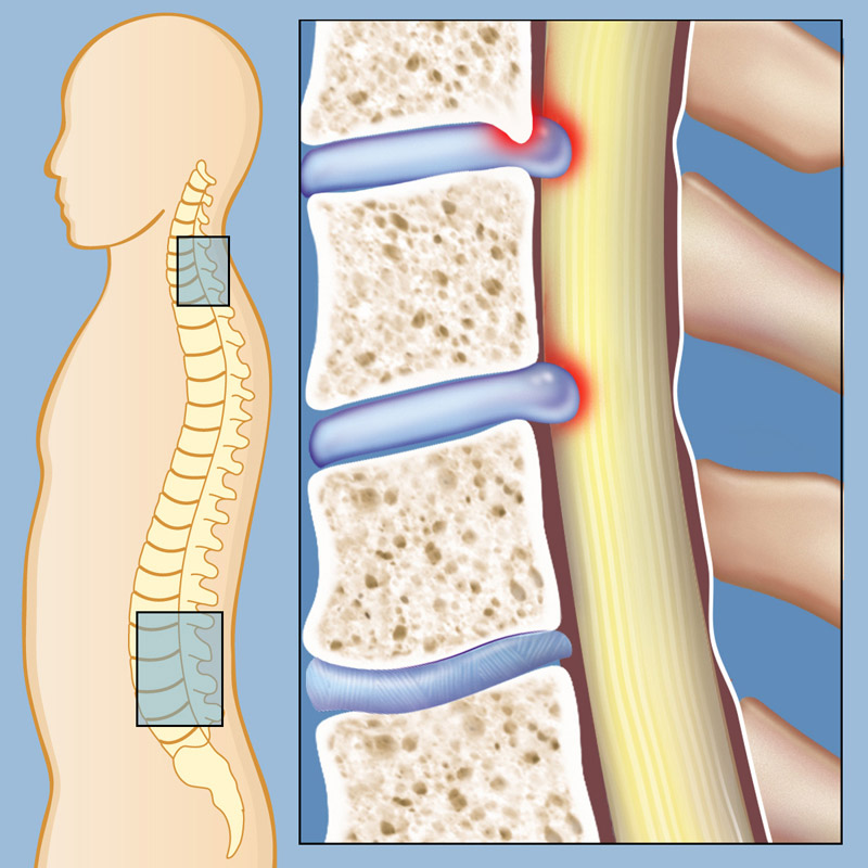 What are the stages of spinal stenosis?