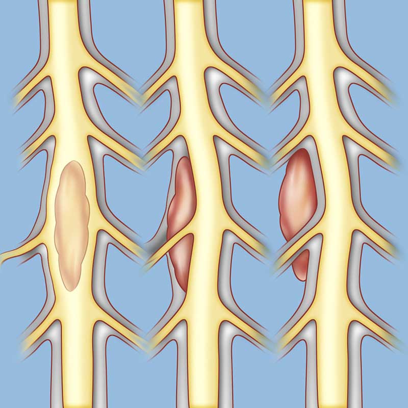 What is spine cancer called?