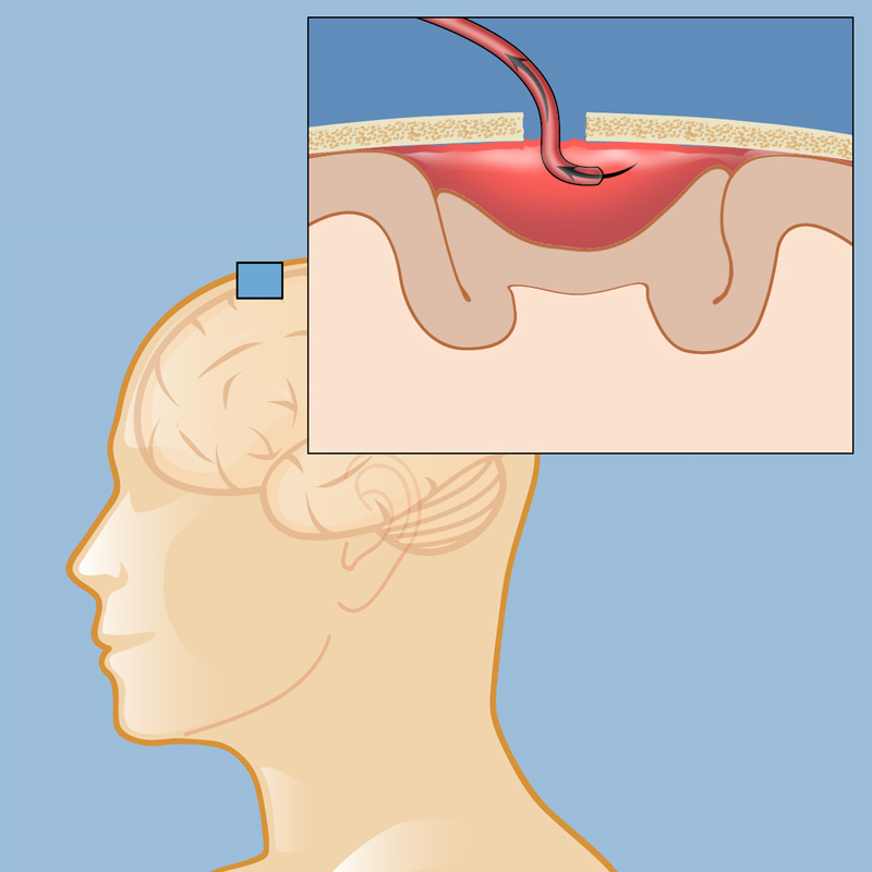 Surgery For Intracerebral Hemorrhage Weill Cornell Brain And Spine Center