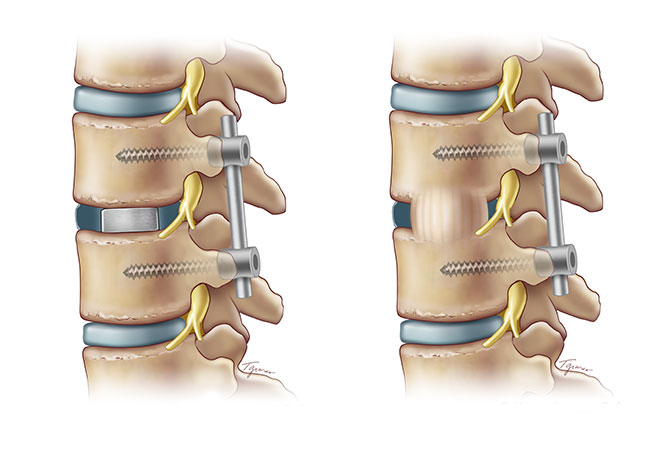 What Is Minimally Invasive Spinal Fusion