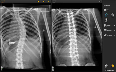 Scoliosis X-ray 2
