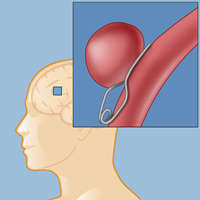 In a clipping procedure, an aneurysm is approached from the outside and clipped off at the base, preventing it from filling with blood