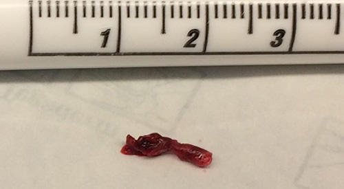 Blood clot removed from patient having a stroke