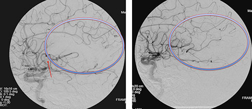 Pre- and post-procedure scans of blood flow 