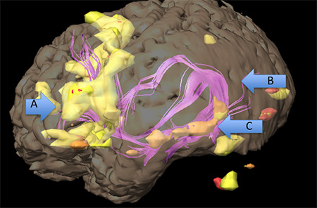 Map of language-related brain areas