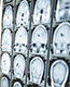 Brain Mets MRI Scans