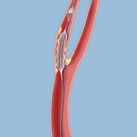 Carotid stenting for carotid occlusive disease