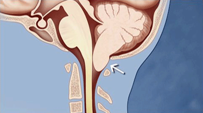 normal cerebellar tonsils