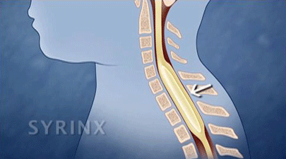 This illustration shows a syrinx, which is a cyst in the spinal column. 