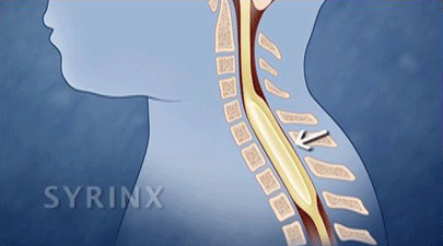 syringomyelia spinal cord