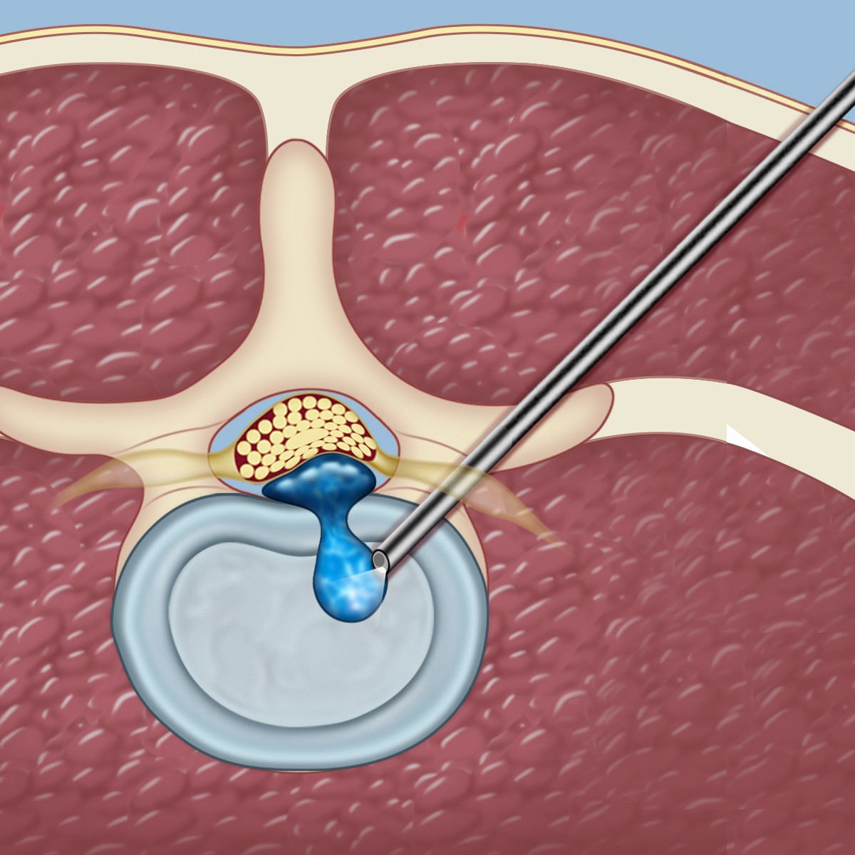 Herniated Disc Surgery Video