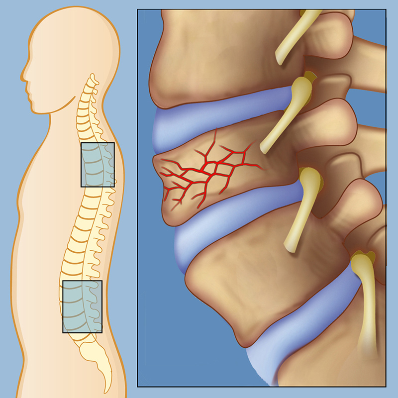 Is Compression Fracture The Same As Wedge Compression Fracture