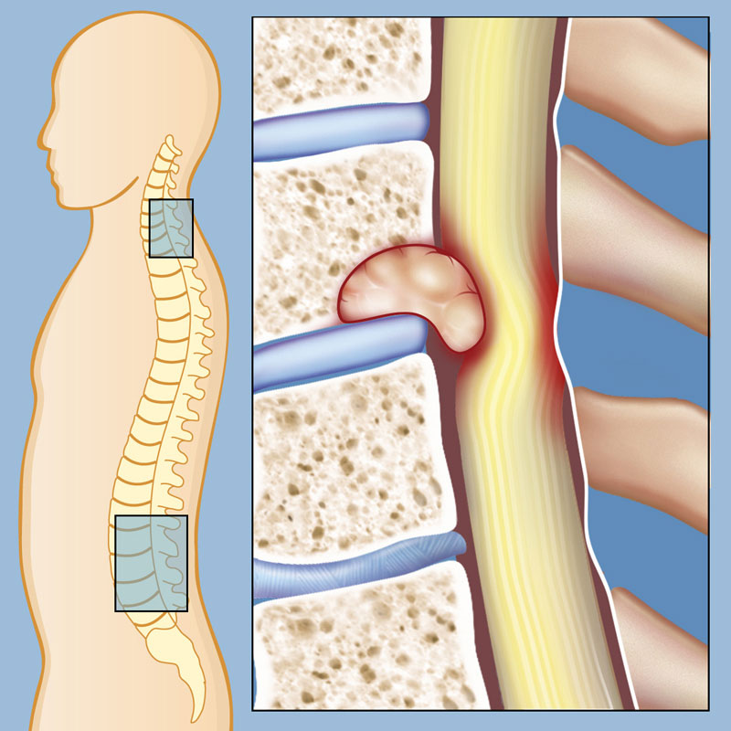 tumores-de-columna-vertebral-sarcoma-cancer-images