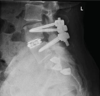 A post-operative x-ray of Dawn's lumbar hardware