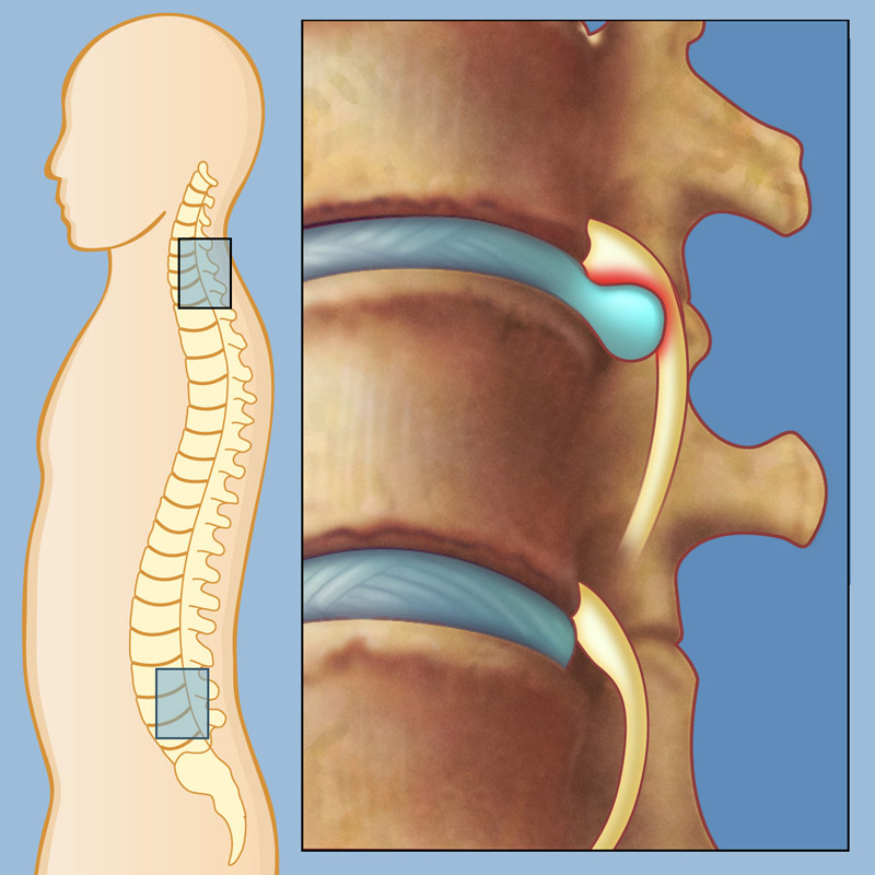 Slip disc treatment