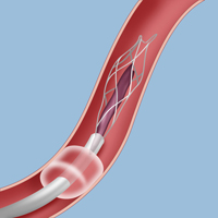 Aspirating a intracranial blood clot