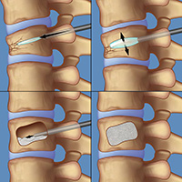 compression fracture treatment kyphoplasty