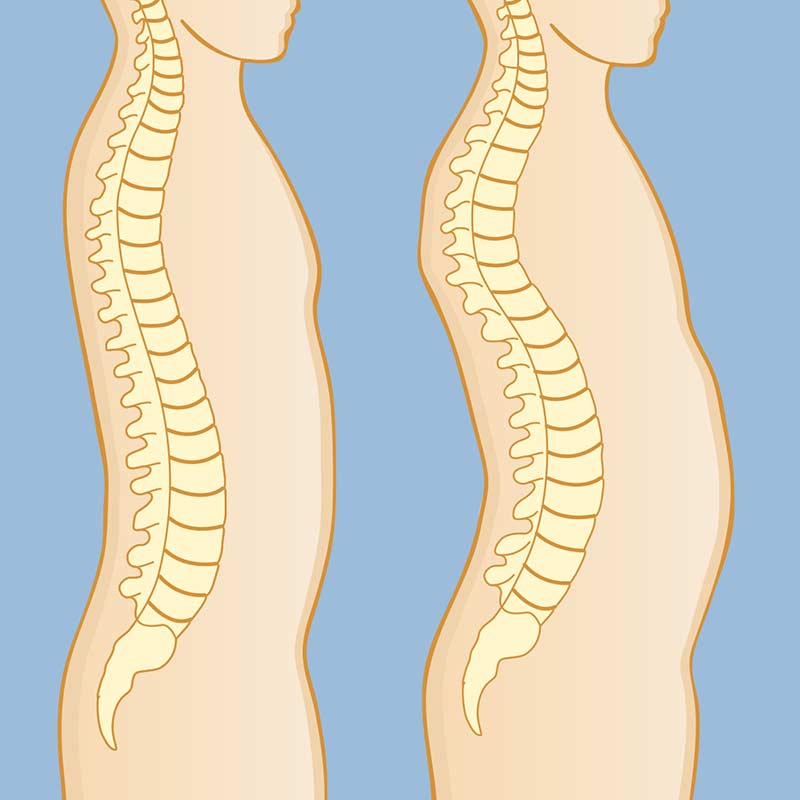 Kyphosis Lg 