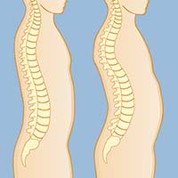 Spinal deformity