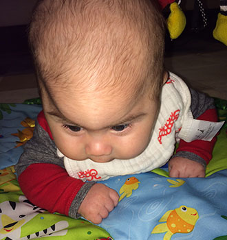 Leo's forehead shows unmistakable signs of metopic synostosis