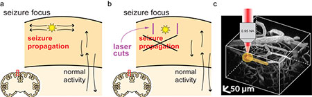 In focal epilepsy, seizure activity spreads along horizontal neural connections (a), but normal brain activity is more vertically organized between layers (b). Subsurface, femtosecond laser cuts could block seizure with minimal collateral damage (c).