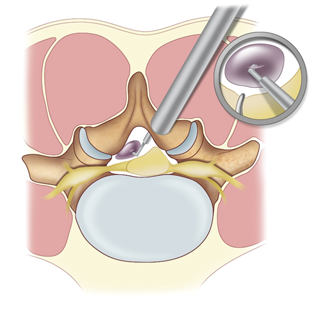 Ten-Step MIS Lumbar Decompression and Dural Repair through Tubular Retractors