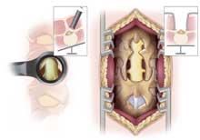 Left: A minimally invasive laminectomy using “over the top” decompression with a tubular retractor system. Right: The traditional open laminectomy technique. Minimally invasive laminectomy using “over the top” decompression with tubular retractor system (left) vs traditional open laminectomy technique.