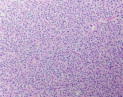 Oligodendroglioma cells under miscroscopic magnification Oligodendroglioma cells under miscroscopic magnification