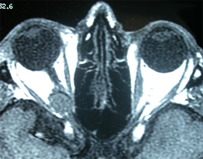 An orbital apex vascular tumor compressing optic nerve