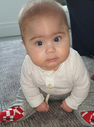 Leo's forehead shows the signs of a fused metopic suture