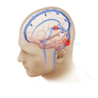 This illustration shows bilateral venous sinus narrowing (red circles). 