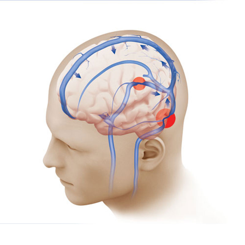 Pulsatile Tinnitus Weill Cornell Brain And Spine Center