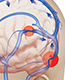Venous sinus stenosis can cause pulsatile tinnitus
