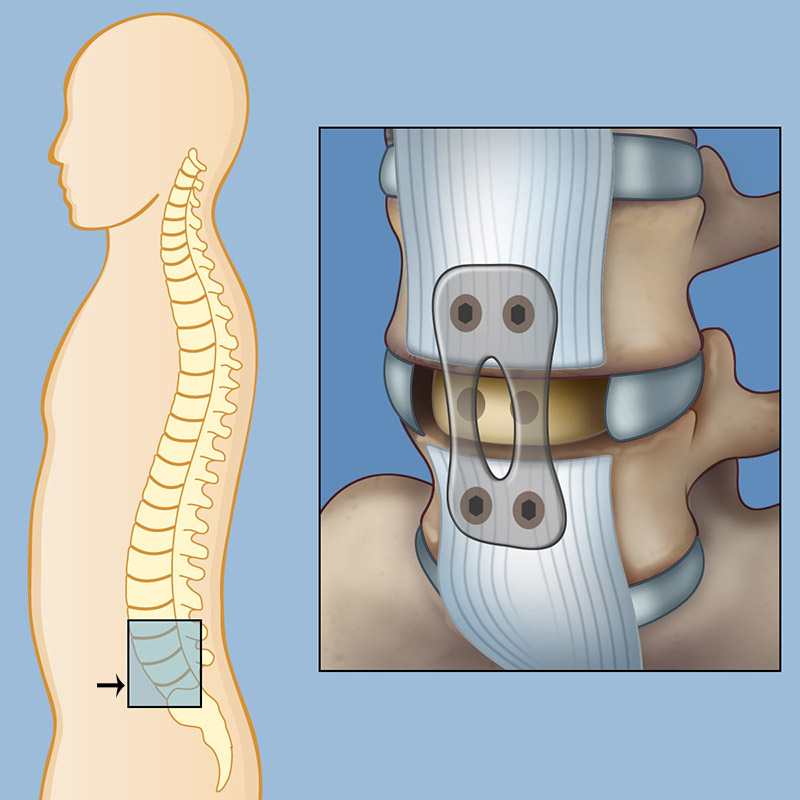 ALIF may be used for spine fusion