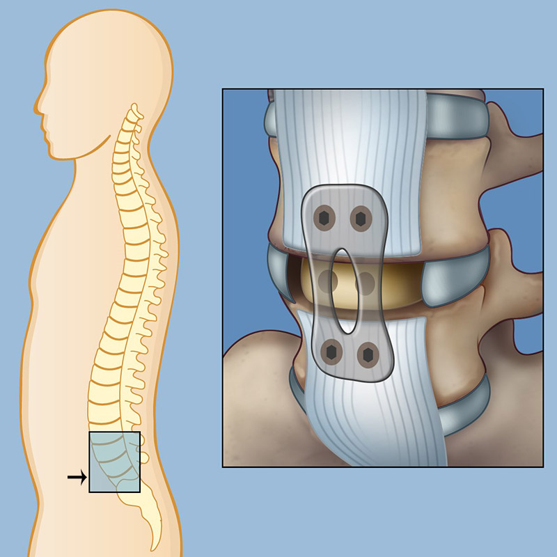 Alif For Spine Fusion Brain Spine Center