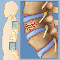 Spinal Compression Fractures | Weill Cornell Brain and Spine Center