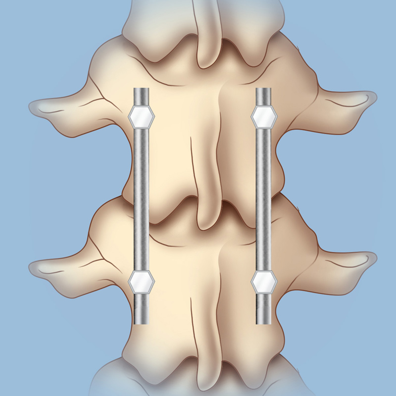 compressed spine treatment