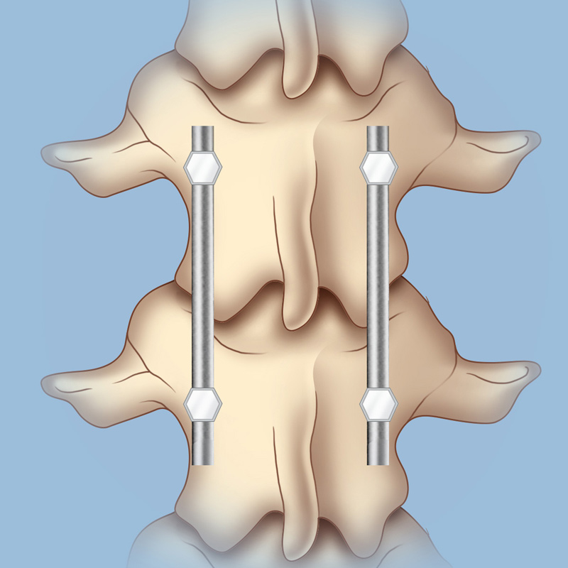 spine fusion