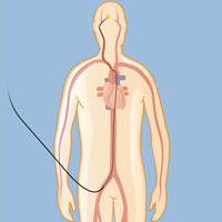 Embolization of a Blood Clot