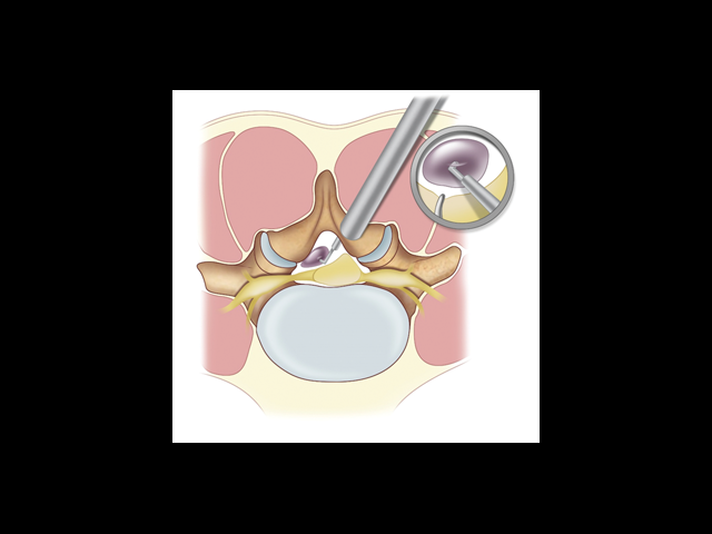 Ten-Step MIS Lumbar Decompression and Dural Repair through Tubular Retractors